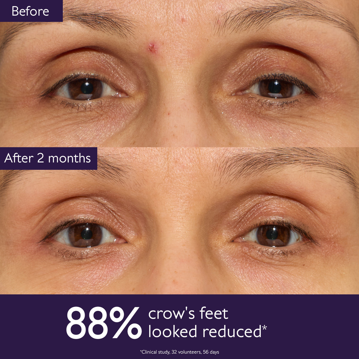 Before and after comparison of crow's feet reduction with text overlay on a close-up of a person's eyes.
