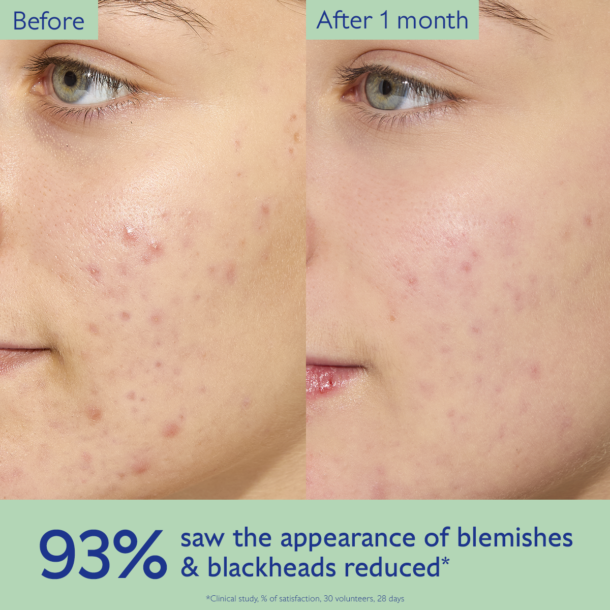 Before and after comparison of acne on a person's face with text indicating improvement.