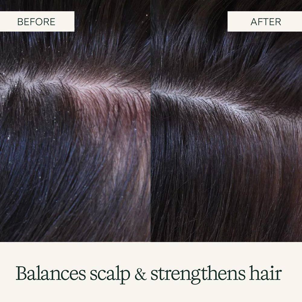 Before and after comparison close-up of a person's dark hair scalp, showing a healthier, less flaky scalp and stronger hair in the 'AFTER' panel, with text reading 'Before' and 'After' and 'Balances scalp & strengthens hair' on a cream background.