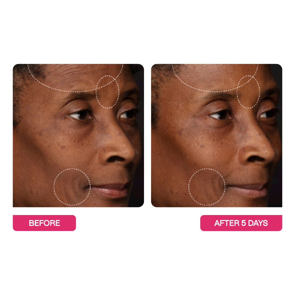 Before and after pictures of a woman's skin from 5 days of using  Peptide Wrinkle Relaxing Moisturizer by BeautyStat