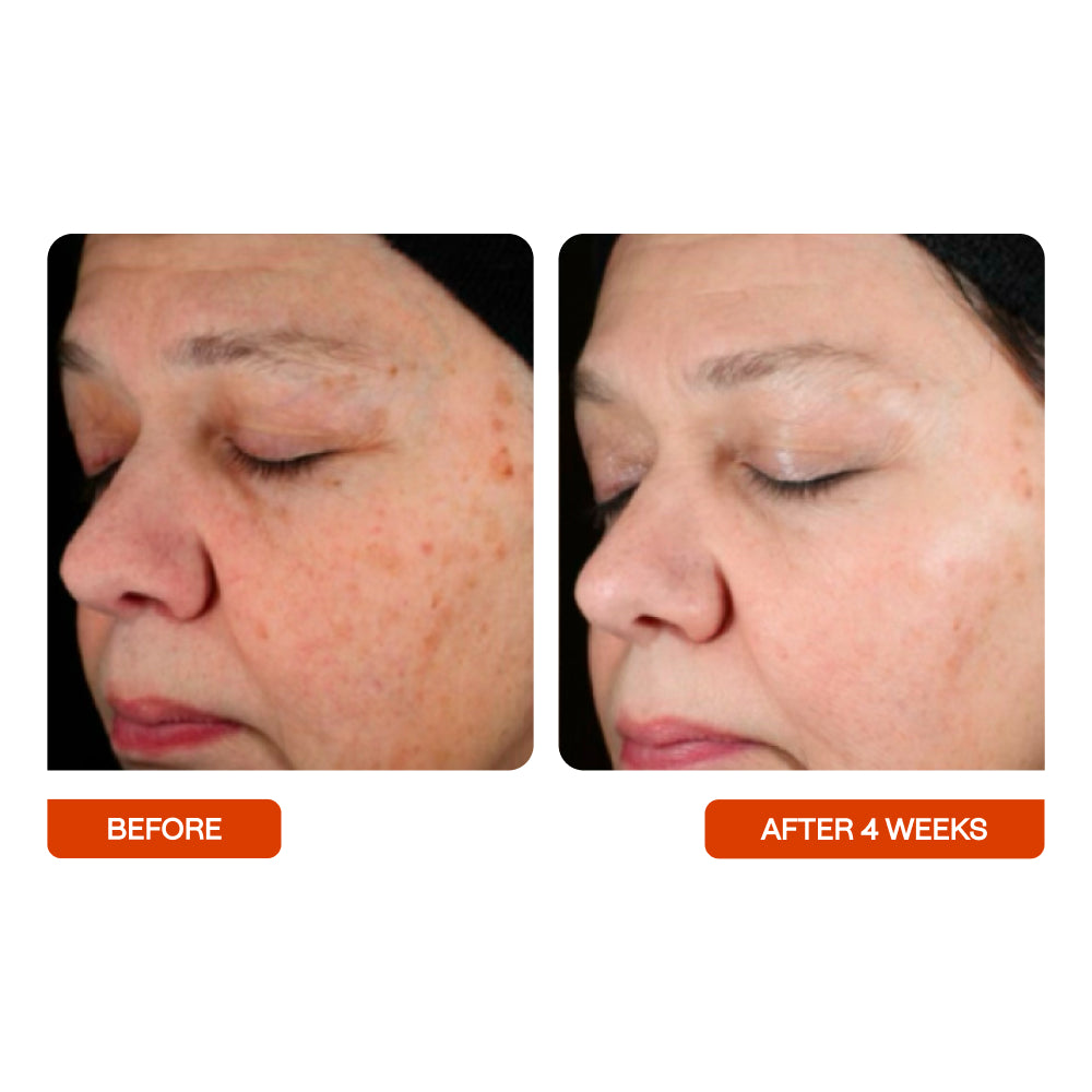 Woman's face before and after 4 weeks of using Universal C Skin Refiner by BeautyStat