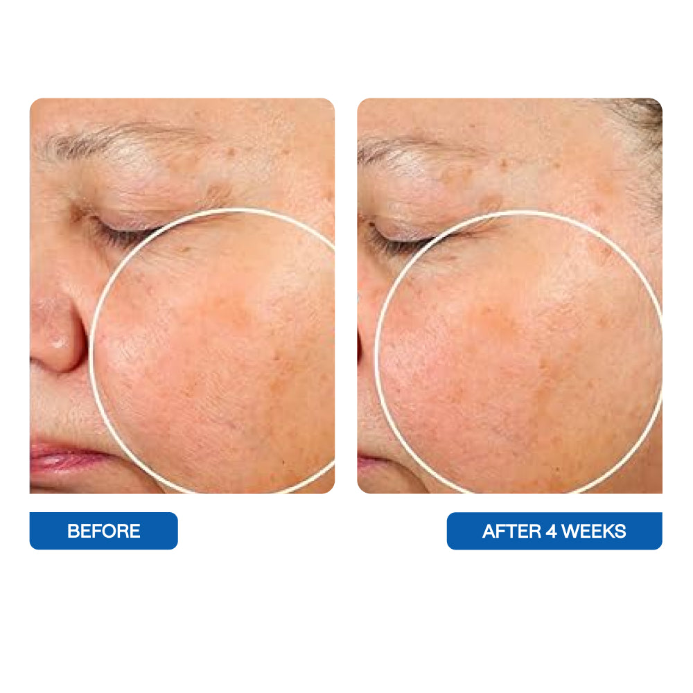 Before and after pictures of a person's skin 4 weeks of using BeautyStat Microbiome Barrier Repair Purifying Cleanser