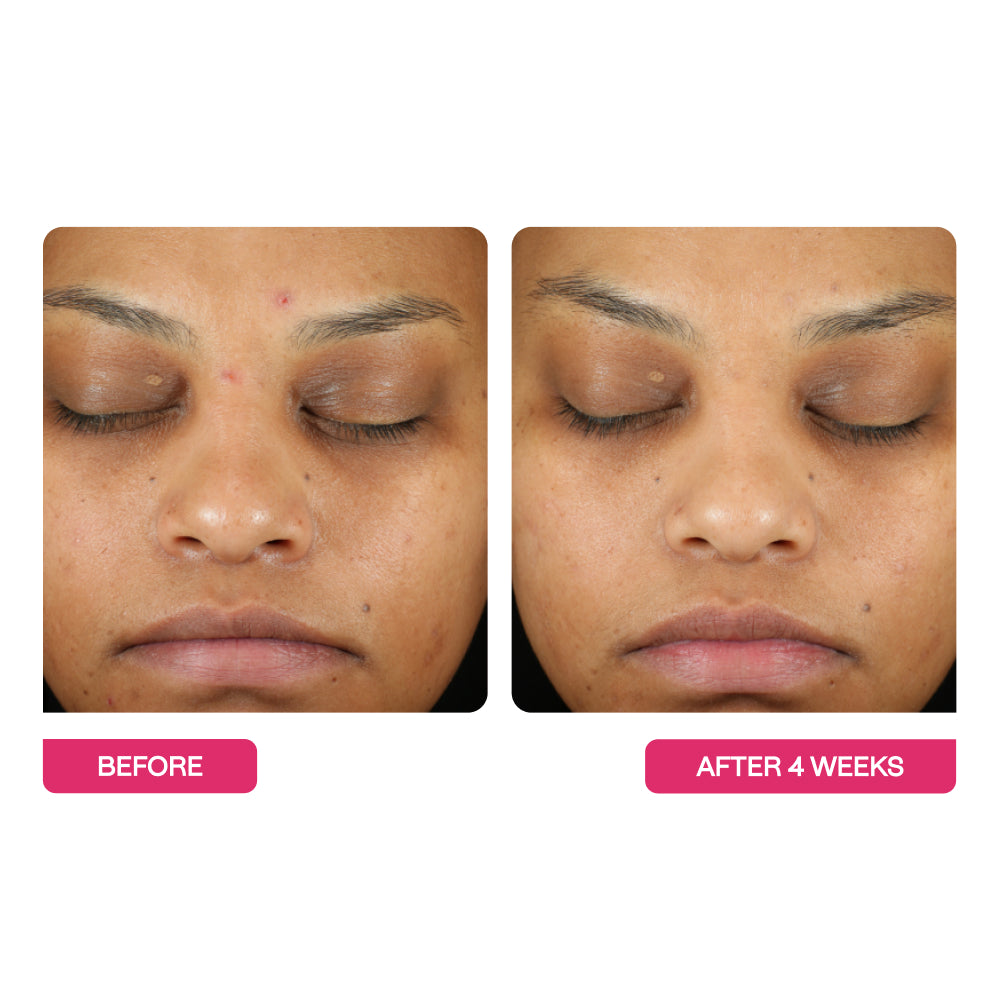 Woman's face before and after 4 weeks using  BeautyStat Universal Triple Action Daily Exfoliating Peel Pads