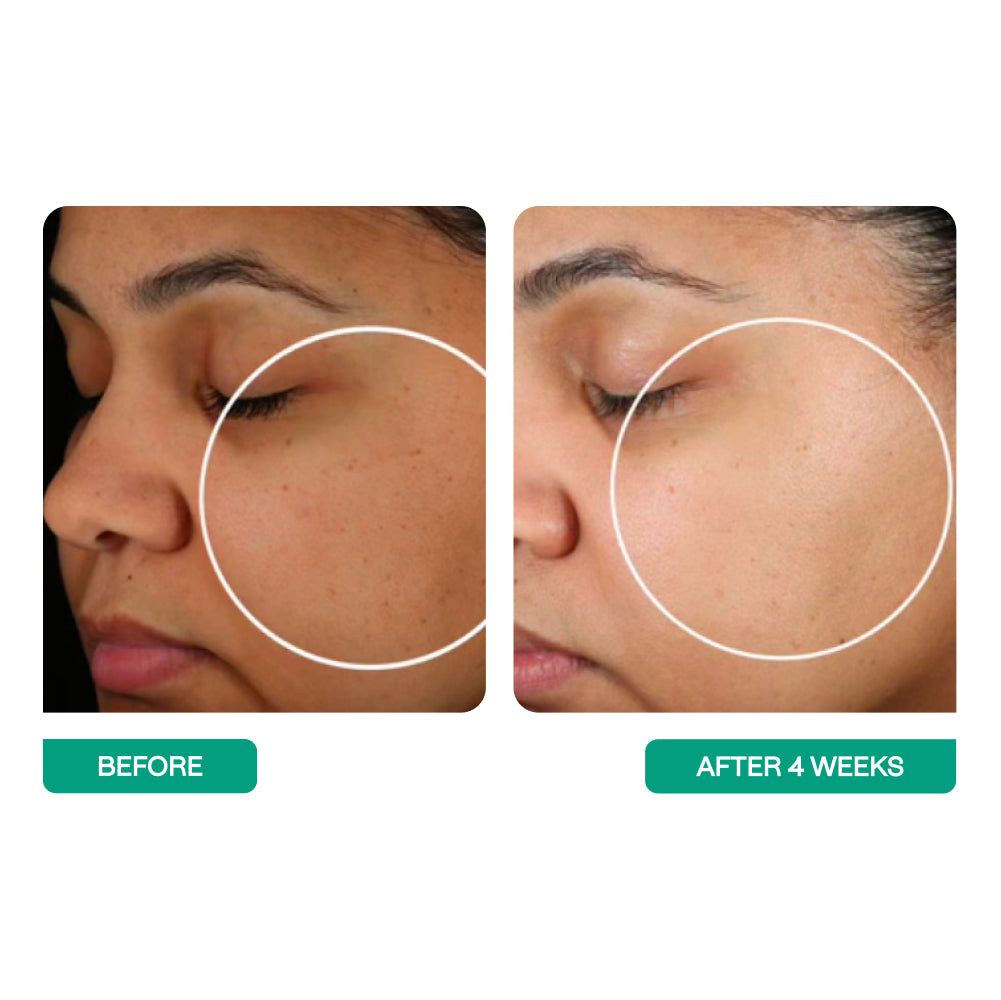 Before and after pictures of a woman's skin 4 weeks of using 'Universal Pro-Bio Moisture Boost Cream' from BeautyStat