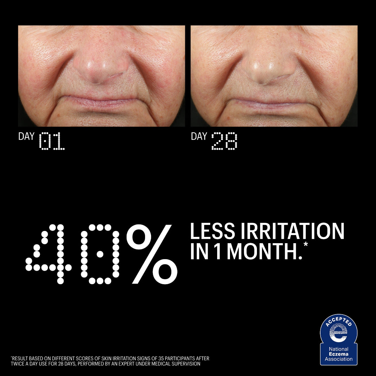 Before and after comparison of skin irritation with text indicating 40% less irritation in 1 month.