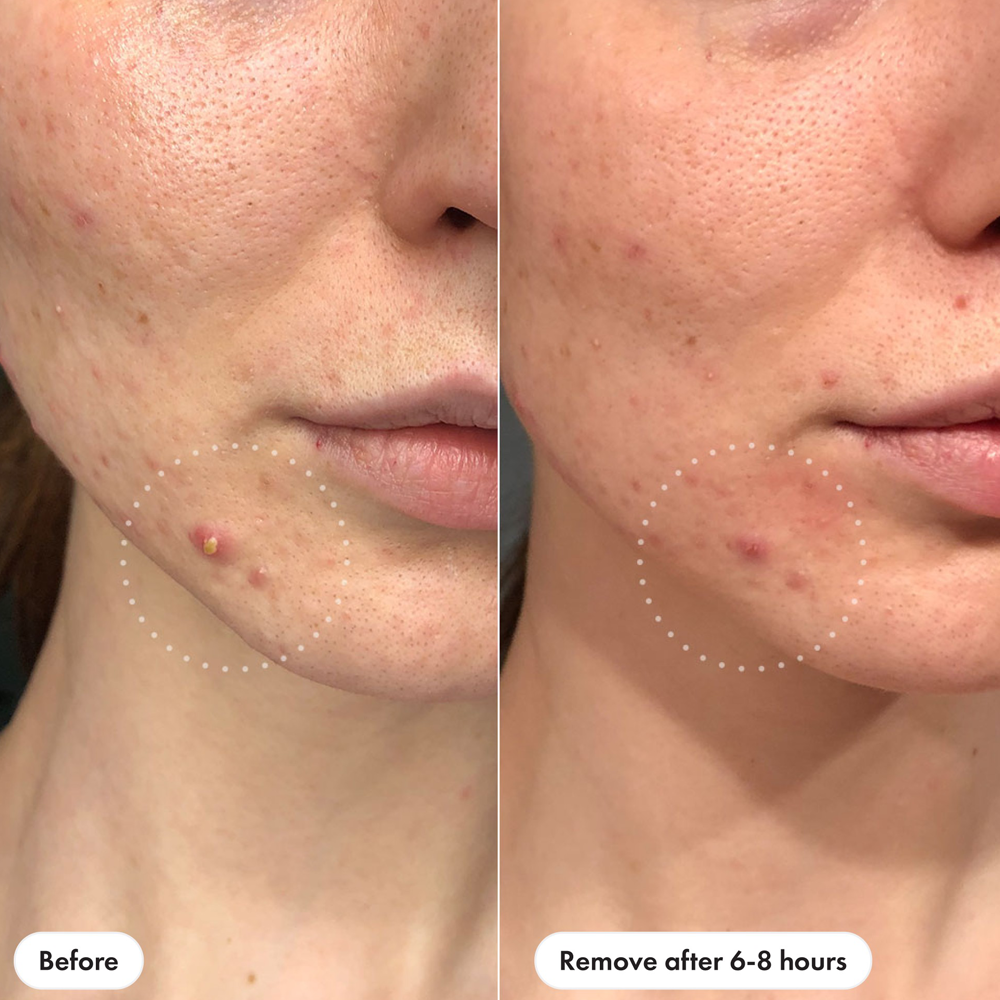 Before and after comparison of skin treatment showing visible improvement.