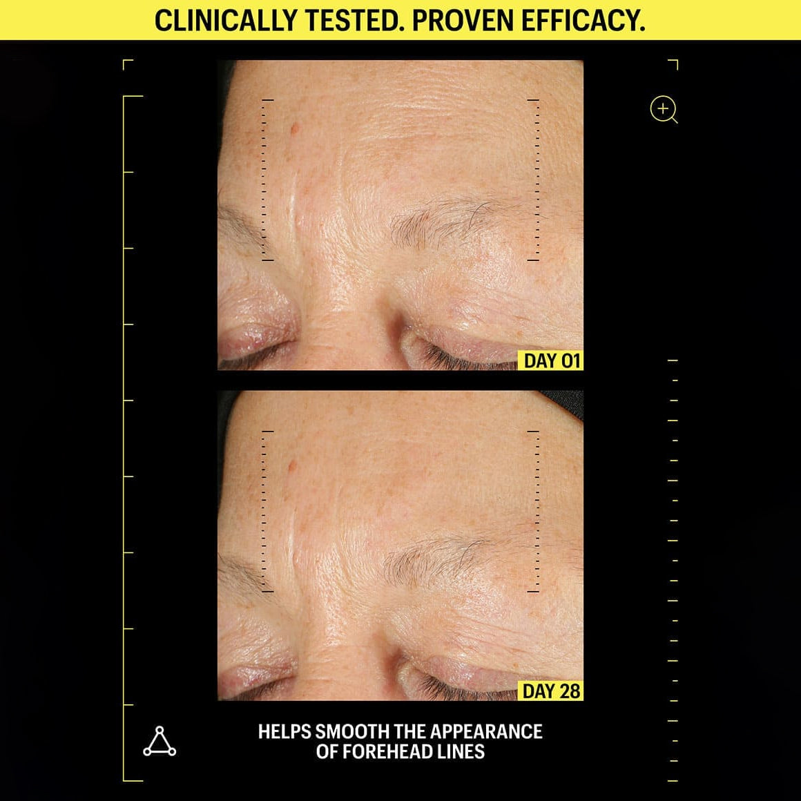 Before and after comparison of forehead lines with clinical testing results.