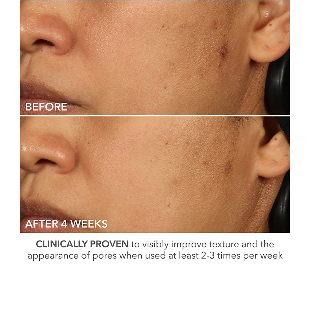 Dr Dennis Gross before and after photo showing before and after 4 weeks. "clinically proven to visibly improve texture and the appearance of pores when used at least 2-3 times per week.